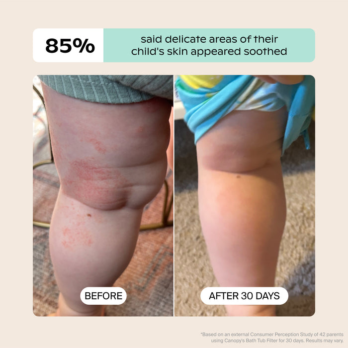 Baby Bath Tub Filter | Lifestyle, Before & After illustrating a child's irritated leg with redness that has faded over 30 days; Based on an external Consumer Perception Study of 42 parents 85% said delicate areas of their child's skin appeared soothed