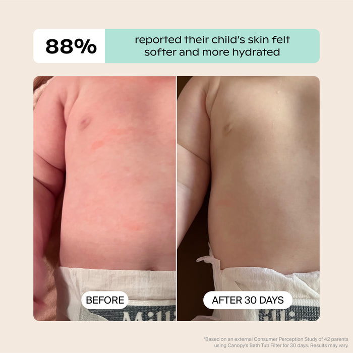 Baby Bath Tub Filter | Lifestyle, Before & After illustrating a child's irritated belly with redness that has faded over 30 days; Based on an external Consumer Perception Study of 42 parents 88% reported their child's skin felt softer and more hydrated